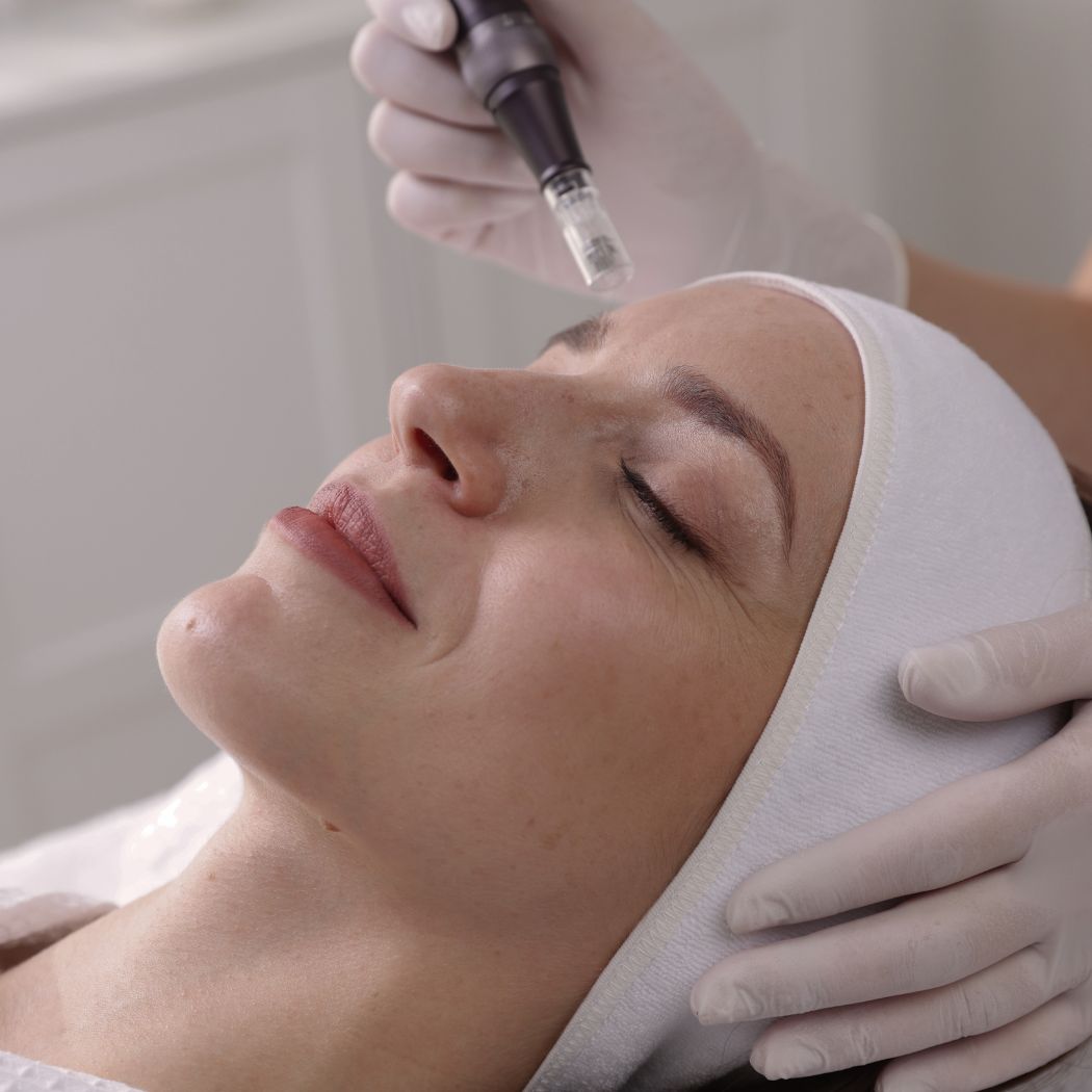 Beauty by Biska Offenbach am Main Microneedling